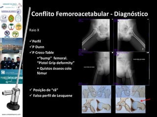 www.unidadedaanca.com 
Conflito Femoroacetabular - Diagnóstico 
Raio X 
Perfil 
P Dunn 
P Cross-Table 
“bump” femoral. 
“Pistol Grip deformity” 
 Quistos ósseos colo 
fémur 
 Posição de “rã” 
 Falso perfil de Lesquene 
 