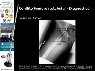 www.unidadedaanca.com 
Conflito Femoroacetabular - Diagnóstico 
Ângulo alfa  < ~55º 
Clohisy J; Carlisle J; Beaule P; Kim Y; Trousdale R; Sierra R; Leunig M; Schoenecker P; Millis M. A sytematic 
approach to the plain radiographic evaluation of the young adult hip. J Bone Joint Surg Am. 2008;90 Suppl 4:47-66 
 