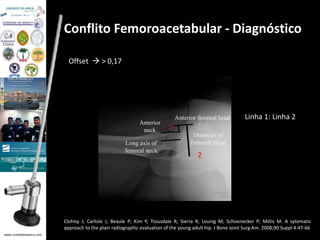 www.unidadedaanca.com 
Conflito Femoroacetabular - Diagnóstico 
Offset  > 0,17 
1 
2 
Linha 1: Linha 2 
Clohisy J; Carlisle J; Beaule P; Kim Y; Trousdale R; Sierra R; Leunig M; Schoenecker P; Millis M. A sytematic 
approach to the plain radiographic evaluation of the young adult hip. J Bone Joint Surg Am. 2008;90 Suppl 4:47-66 
 