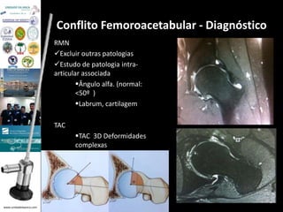 www.unidadedaanca.com 
Conflito Femoroacetabular - Diagnóstico 
RMN 
Excluir outras patologias 
Estudo de patologia intra-articular 
associada 
Ângulo alfa. (normal: 
<50º ) 
Labrum, cartilagem 
TAC 
TAC 3D Deformidades 
complexas 
 
