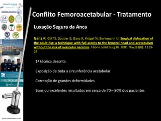 www.unidadedaanca.com 
Conflito Femoroacetabular - Tratamento 
Luxação Segura da Anca 
Ganz R, Gill TJ, Gautier E, Ganz K, Krügel N, Berlemann U. Surgical dislocation of 
the adult hip: a technique with full access to the femoral head and acetabulum 
without the risk of avascular necrosis. J Bone Joint Surg Br. 2001 Nov;83(8): 1119- 
24 
1ª técnica descrita 
Exposição de toda a circunferência acetabular 
Correcção de grandes deformidades 
Bons ou excelentes resultados em cerca de 70 – 80% dos pacientes 
 