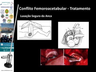 www.unidadedaanca.com 
Conflito Femoroacetabular - Tratamento 
Luxação Segura da Anca 
 