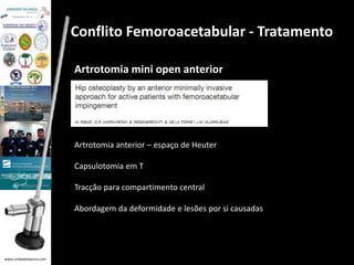 www.unidadedaanca.com 
Conflito Femoroacetabular - Tratamento 
Artrotomia mini open anterior 
Artrotomia anterior – espaço de Heuter 
Capsulotomia em T 
Tracção para compartimento central 
Abordagem da deformidade e lesões por si causadas 
 