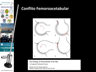 www.unidadedaanca.com 
Conflito Femoroacetabular 
 