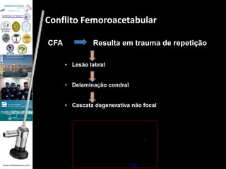 www.unidadedaanca.com 
Conflito Femoroacetabular 
CFA Resulta em trauma de repetição 
• Lesão labral 
• Delaminação condral 
• Cascata degenerativa não focal 
 