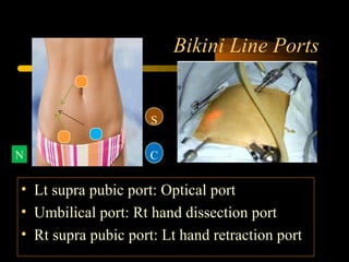 Bikini Line Ports
• Lt supra pubic port: Optical port
• Umbilical port: Rt hand dissection port
• Rt supra pubic port: Lt hand retraction port
S
CN
 