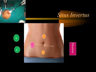 Situs Invertus
C
S
C
Monitor
 