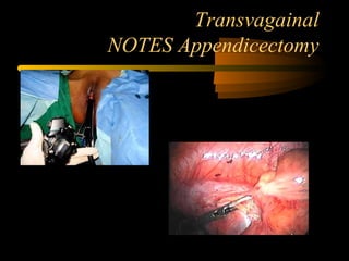Transvagainal
NOTES Appendicectomy
 