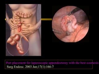 Port placement for laparoscopic appendectomy with the best cosmesis
Surg Endosc. 2003 Jan;17(1):166-7
 