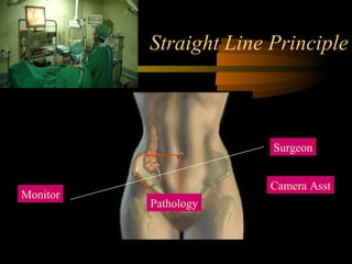 Straight Line Principle
Surgeon
Pathology
Monitor
Camera Asst
 