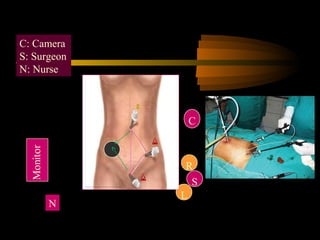 S
C
R
L
P
N
C: Camera
S: Surgeon
N: Nurse
 