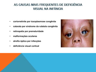 • coriorretinite por toxoplasmose congênita
• catarata por síndrome da rubéola congênita
• retinopatia por prematuridade
• malformações oculares
• atrofia óptica por infecções
• deficiência visual cortical
 