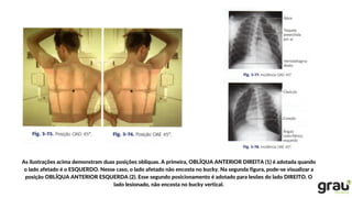 As ilustrações acima demonstram duas posições oblíquas. A primeira, OBLÍQUA ANTERIOR DIREITA (1) é adotada quando
o lado afetado é o ESQUERDO. Nesse caso, o lado afetado não encosta no bucky. Na segunda figura, pode-se visualizar a
posição OBLÍQUA ANTERIOR ESQUERDA (2). Esse segundo posicionamento é adotado para lesões do lado DIREITO. O
lado lesionado, não encosta no bucky vertical.
 