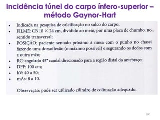 Incidência túnel do carpo ínfero-superior – método Gaynor-Hart100
