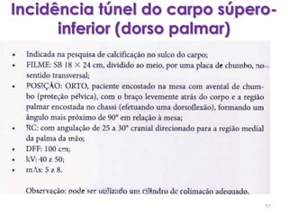 Incidência túnel do carpo súpero-inferior (dorso palmar)97