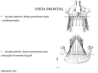 VISTA FRONTAL
• Arcada superior: dentes posteriores mais
vestibularizados
• Arcada inferior: dentes posteriores com
colocação levemente lingual
OKESON,1992
 