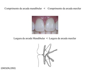 Comprimento da arcada mandibular < Comprimento da arcada maxilar
Largura da arcada Mandibular < Largura da arcada maxilar
(OKESON,1992)
 