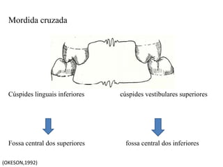 Mordida cruzada
Cúspides linguais inferiores cúspides vestibulares superiores
Fossa central dos superiores fossa central dos inferiores
(OKESON,1992)
 