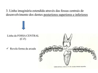3. Linha imaginária estendida através das fossas centrais de
desenvolvimento dos dentes posteriores superiores e inferiores
Linha da FOSSA CENTRAL
(C-F)
 Revela forma da arcada
 