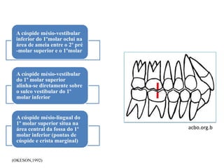 A cúspide mésio-vestibular
inferior do 1ºmolar oclui na
área de ameia entre o 2º pré
-molar superior e o 1ºmolar
A cúspide mésio-vestibular
do 1º molar superior
alinha-se diretamente sobre
o sulco vestibular do 1º
molar inferior
A cúspide mésio-lingual do
1º molar superior situa na
área central da fossa do 1º
molar inferior (pontas de
cúspide e crista marginal)
(OKESON,1992)
acbo.org.b
 