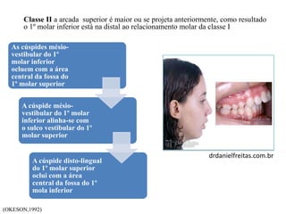 Classe II a arcada superior é maior ou se projeta anteriormente, como resultado
o 1º molar inferior está na distal ao relacionamento molar da classe I
As cúspides mésio-
vestibular do 1º
molar inferior
ocluem com a área
central da fossa do
1º molar superior
A cúspide mésio-
vestibular do 1º molar
inferior alinha-se com
o sulco vestibular do 1º
molar superior
A cúspide disto-lingual
do 1º molar superior
oclui com a área
central da fossa do 1º
mola inferior
(OKESON,1992)
drdanielfreitas.com.br
 