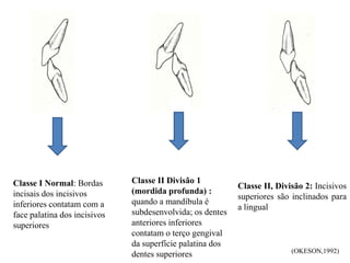 Classe I Normal: Bordas
incisais dos incisivos
inferiores contatam com a
face palatina dos incisivos
superiores
Classe II, Divisão 2: Incisivos
superiores são inclinados para
a lingual
(OKESON,1992)
Classe II Divisão 1
(mordida profunda) :
quando a mandíbula é
subdesenvolvida; os dentes
anteriores inferiores
contatam o terço gengival
da superfície palatina dos
dentes superiores
 
