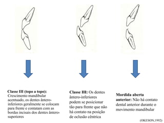 Classe III (topo a topo):
Crescimento mandibular
acentuado, os dentes ântero-
inferiores geralmente se colocam
para frente e contatam com as
bordas incisais dos dentes ântero-
superiores
Classe III: Os dentes
ântero-inferiores
podem se posicionar
tão para frente que não
há contato na posição
de oclusão cêntrica
Mordida aberta
anterior: Não há contato
dental anterior durante o
movimento mandibular
(OKESON,1992)
 