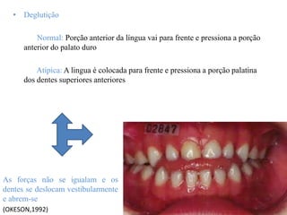 • Deglutição
Normal: Porção anterior da língua vai para frente e pressiona a porção
anterior do palato duro
Atípica: A lingua é colocada para frente e pressiona a porção palatina
dos dentes superiores anteriores
As forças não se igualam e os
dentes se deslocam vestibularmente
e abrem-se
(OKESON,1992)
 