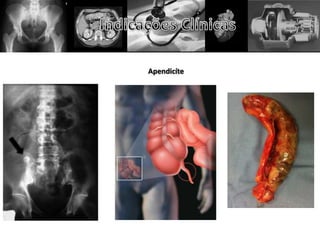 Apendicíte
 