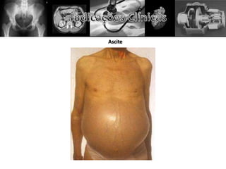 Ascite
 