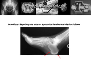 Osteófitos = Esporão parte anterior e posterior da tuberosidade do calcâneo
 