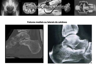 Fraturas mediais ou laterais do calcâneo
 