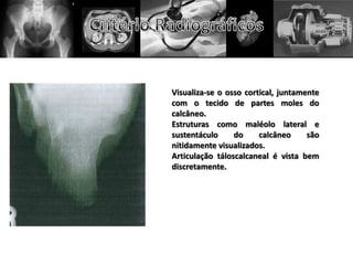 Visualiza-se o osso cortical, juntamente
com o tecido de partes moles do
calcâneo.
Estruturas como maléolo lateral e
sustentáculo     do     calcâneo     são
nitidamente visualizados.
Articulação táloscalcaneal é vista bem
discretamente.
 