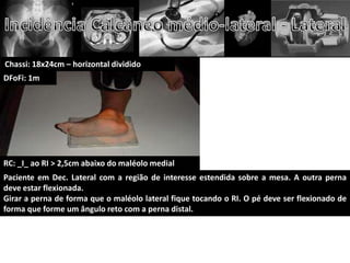 Chassi: 18x24cm – horizontal dividido
DFoFi: 1m




RC: _I_ ao RI > 2,5cm abaixo do maléolo medial
Paciente em Dec. Lateral com a região de interesse estendida sobre a mesa. A outra perna
deve estar flexionada.
Girar a perna de forma que o maléolo lateral fique tocando o RI. O pé deve ser flexionado de
forma que forme um ângulo reto com a perna distal.
 