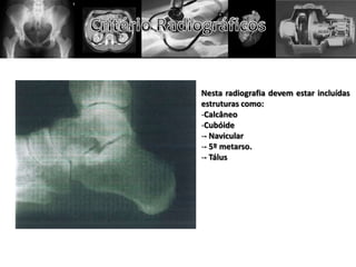 Nesta radiografia devem estar incluídas
estruturas como:
-Calcâneo
-Cubóide
-- Navicular
-- 5º metarso.
-- Tálus
 