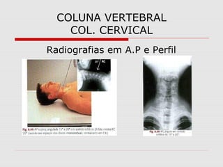 COLUNA VERTEBRAL
COL. CERVICAL
Radiografias em A.P e Perfil

 