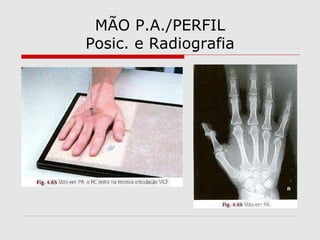 MÃO P.A./PERFIL
Posic. e Radiografia

 