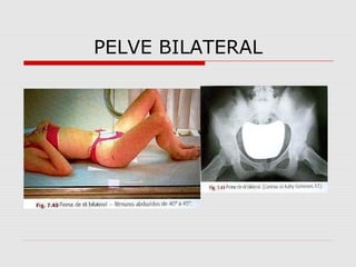 PELVE BILATERAL

 