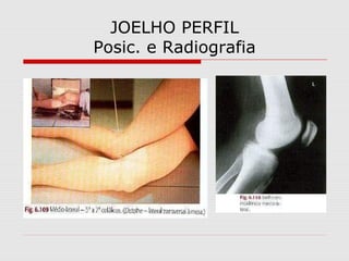 JOELHO PERFIL
Posic. e Radiografia

 