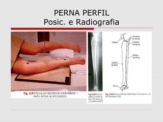 PERNA PERFIL
Posic. e Radiografia

 