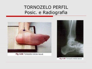 TORNOZELO PERFIL
Posic. e Radiografia

 