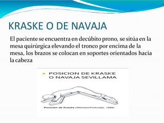 KRASKE O DE NAVAJA
El paciente se encuentra en decúbito prono, se sitúaen la
mesa quirúrgica elevando el tronco por encima de la
mesa, los brazos se colocan en soportes orientados hacia
lacabeza
 