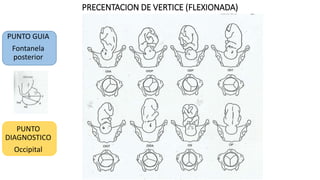 PRECENTACION DE VERTICE (FLEXIONADA)
PUNTO GUIA
Fontanela
posterior
PUNTO
DIAGNOSTICO
Occipital
 