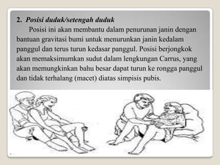 2. Posisi duduk/setengah duduk
Posisi ini akan membantu dalam penurunan janin dengan
bantuan gravitasi bumi untuk menurunkan janin kedalam
panggul dan terus turun kedasar panggul. Posisi berjongkok
akan memaksimumkan sudut dalam lengkungan Carrus, yang
akan memungkinkan bahu besar dapat turun ke rongga panggul
dan tidak terhalang (macet) diatas simpisis pubis.

 