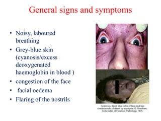 General signs and symptoms
• Noisy, laboured
breathing
• Grey-blue skin
(cyanosis/excess
deoxygenated
haemoglobin in blood )
• congestion of the face
• facial oedema
• Flaring of the nostrils
 