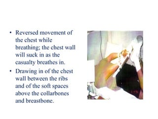 • Reversed movement of
the chest while
breathing; the chest wall
will suck in as the
casualty breathes in.
• Drawing in of the chest
wall between the ribs
and of the soft spaces
above the collarbones
and breastbone.
 