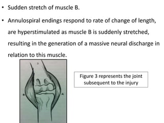 • Sudden stretch of muscle B.
• Annulospiral endings respond to rate of change of length,
are hyperstimulated as muscle B is suddenly stretched,
resulting in the generation of a massive neural discharge in
relation to this muscle.
Figure 3 represents the joint
subsequent to the injury
 