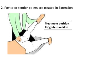 2. Posterior tendor points are treated in Extension
Treatment position
for gluteus medius
 