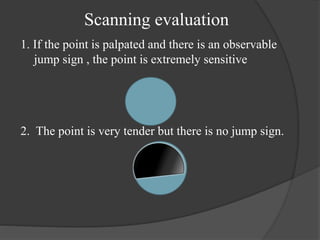 1. If the point is palpated and there is an observable
jump sign , the point is extremely sensitive
2. The point is very tender but there is no jump sign.
Scanning evaluation
 