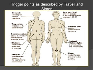 Trigger points as described by Travell and
Simon
 